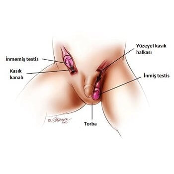 Bebeklerde İnmemiş Testis