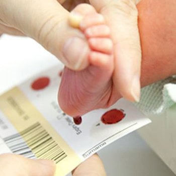 Fenilketonüri (PKU) Nedir? Belirtileri ve Tedavisi